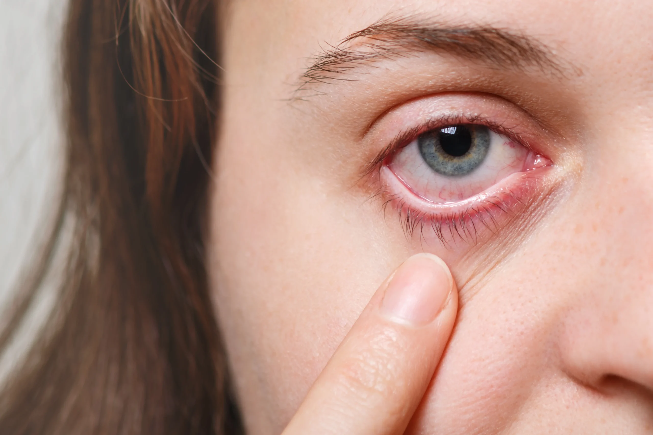 medicine-health-care-eyesight-concept-unrecognizable-female-shows-her-inflated-red-eye-with-blood-capillary